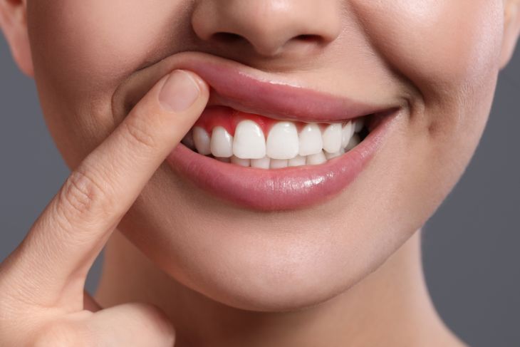 Myth About gum diseases