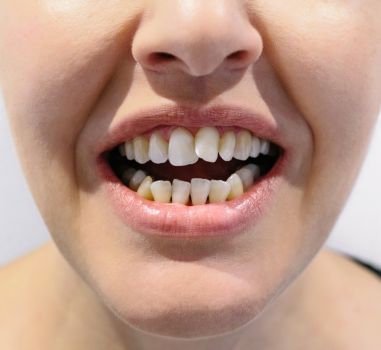 braces treatment in mahim