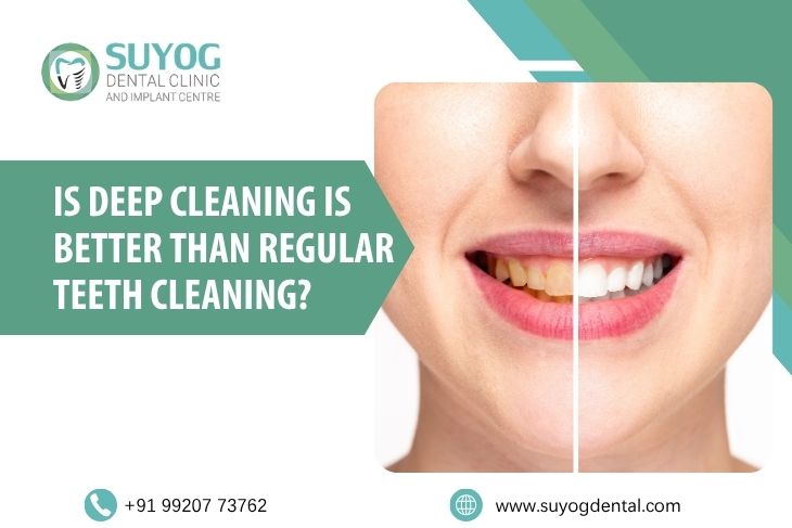 Is Deep Cleaning Is Better Than Regular Teeth Cleaning?