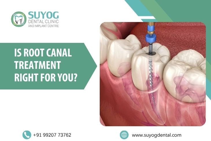 Is Root Canal Treatment Right For You?