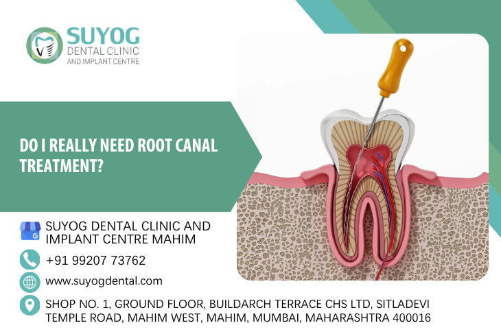 Do I really need root canal treatment?